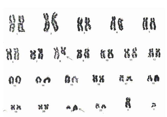 Incidence of structural chromosomal anomalies in patients of acute ...